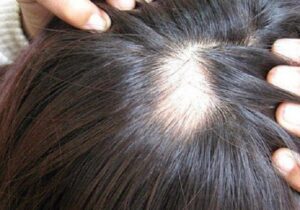 Rụng tóc quá mức là khi tóc bạn rựng quá nhiều và đầu bạn bắt đầu xuất hiện những mảng hói nhỏ.